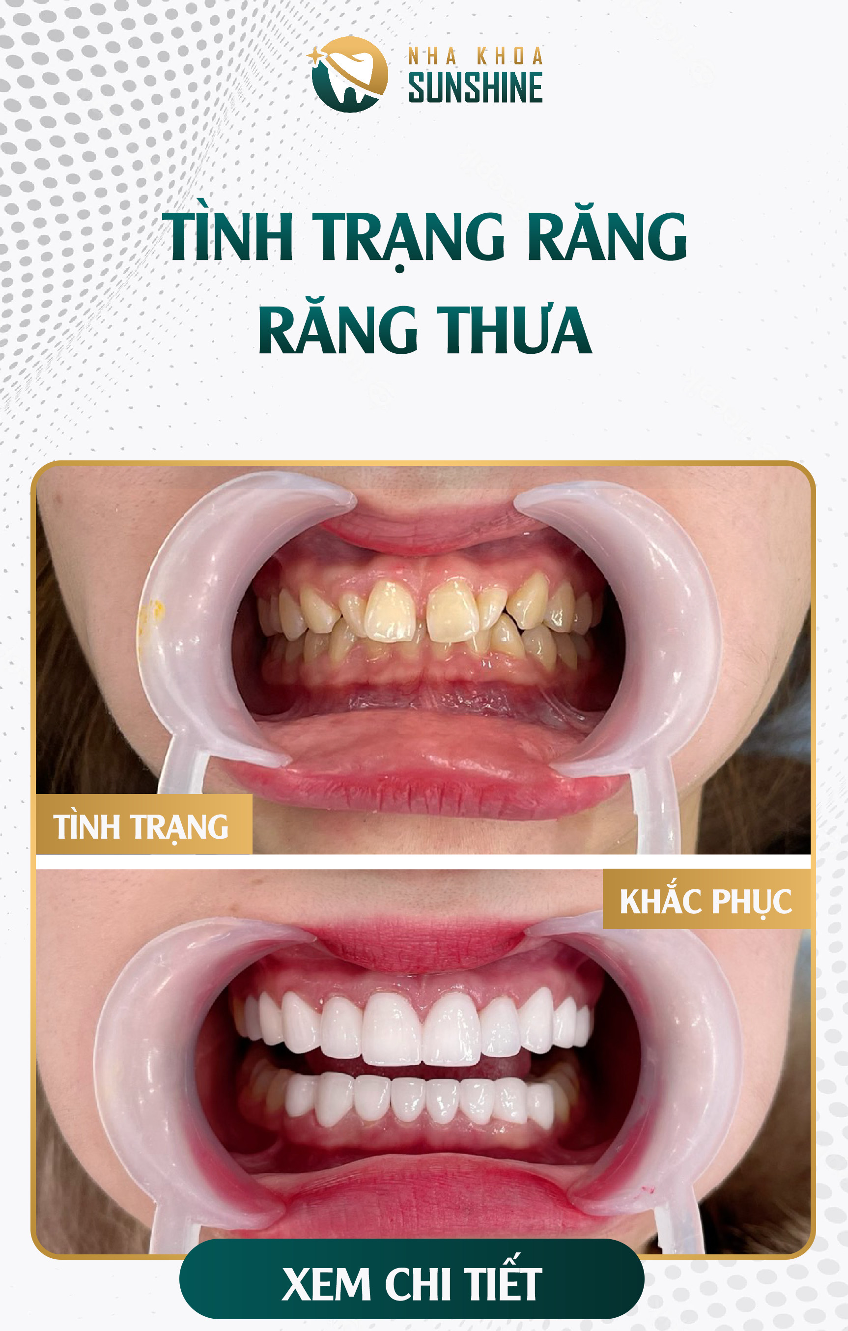 Khuyến mãi cực lớn - Bọc răng sứ giảm ngay 50% chi phí Fancy-rangthua