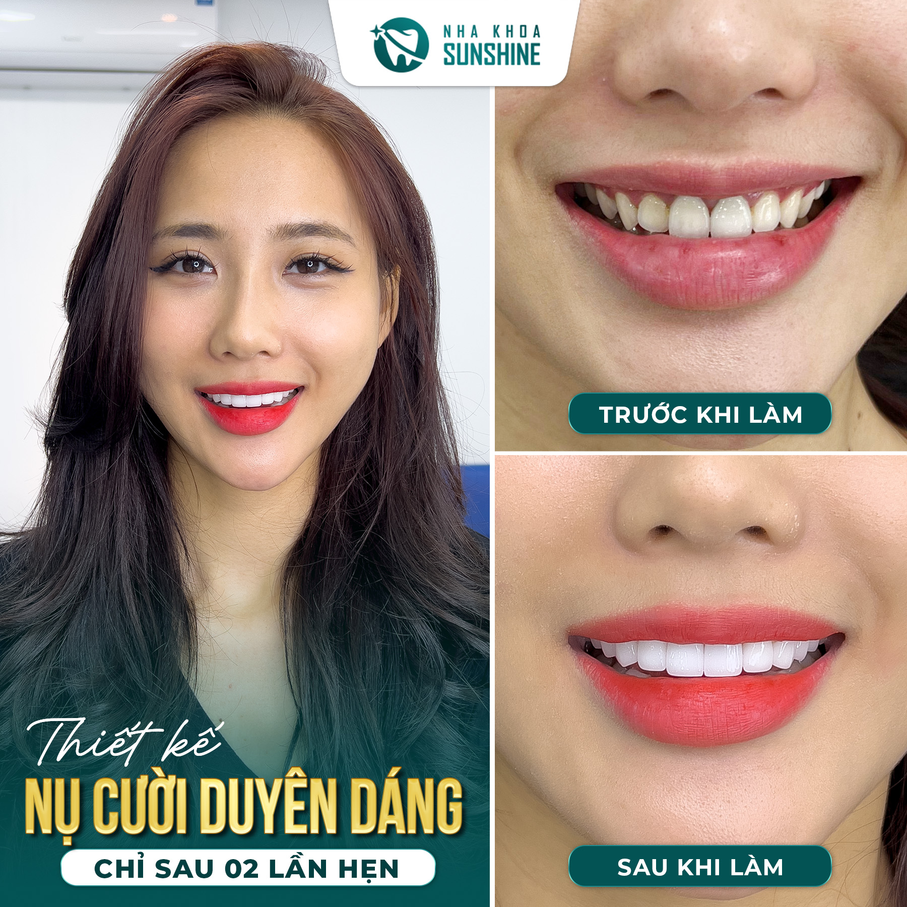 truoc-va-sau-khi-lam-boc-rang-su