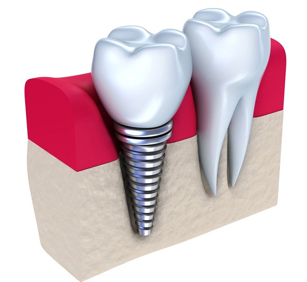 biến chứng khi cấy ghép Implant biến chứng khi cấy ghép Implant