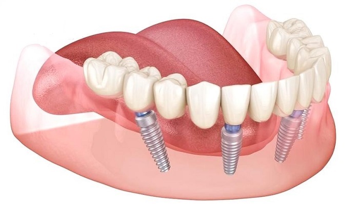 biến chứng khi cấy ghép Implant biến chứng khi cấy ghép Implant