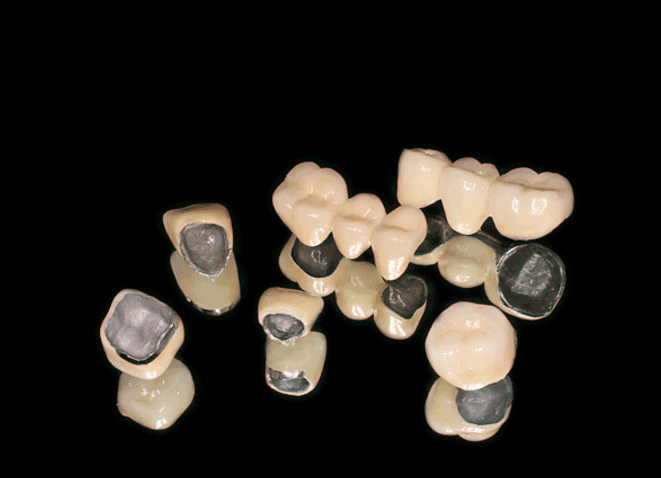 bọc răng sứ bị đen chân răng