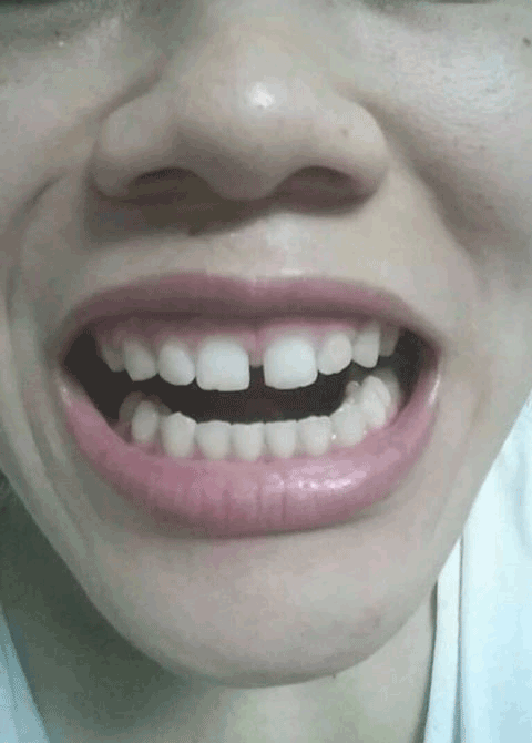 bọc răng sứ bị vỡ