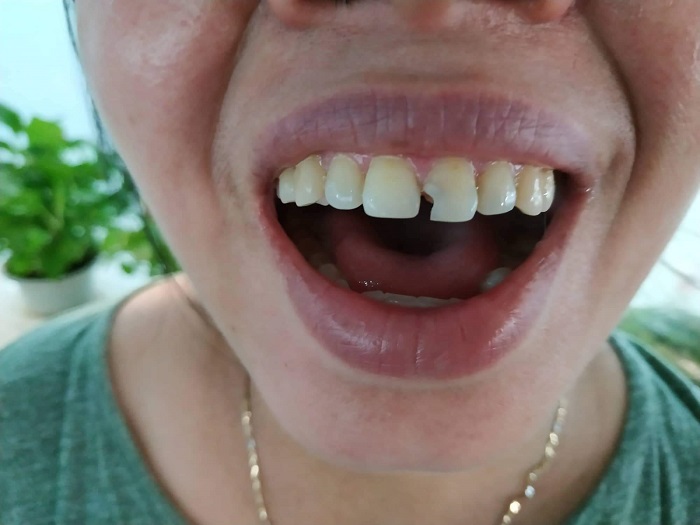 bọc răng sứ cho răng cửa giá bao nhiêu