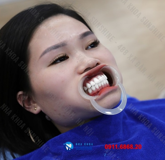 bọc răng sứ hàm dưới