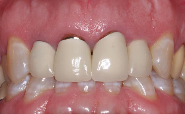 bọc răng sứ inox