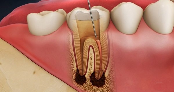 bọc răng sứ lấy tủy có đau không