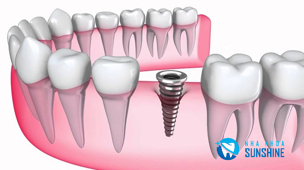 các bước cấy ghép Implant các bước cấy ghép Implant