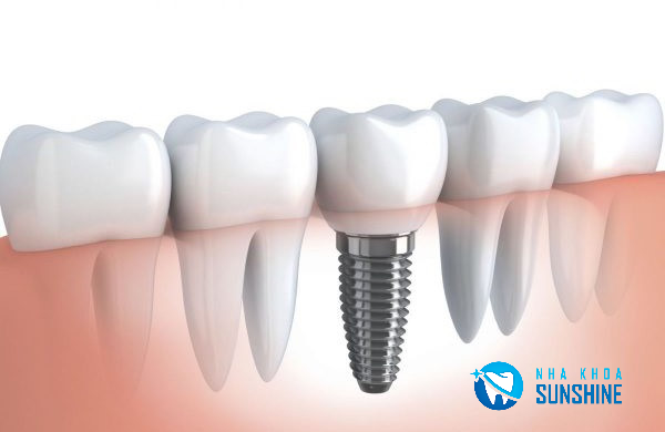 các bước cấy ghép Implant các bước cấy ghép Implant