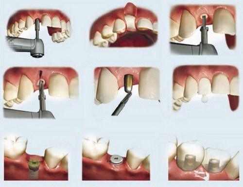 cách trồng răng hàm giả