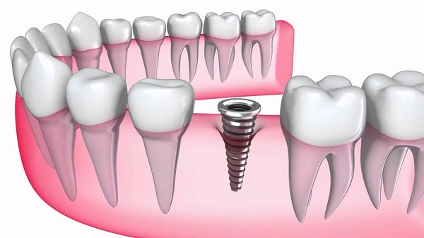 cấy ghép Implant trong thời gian bao lâu