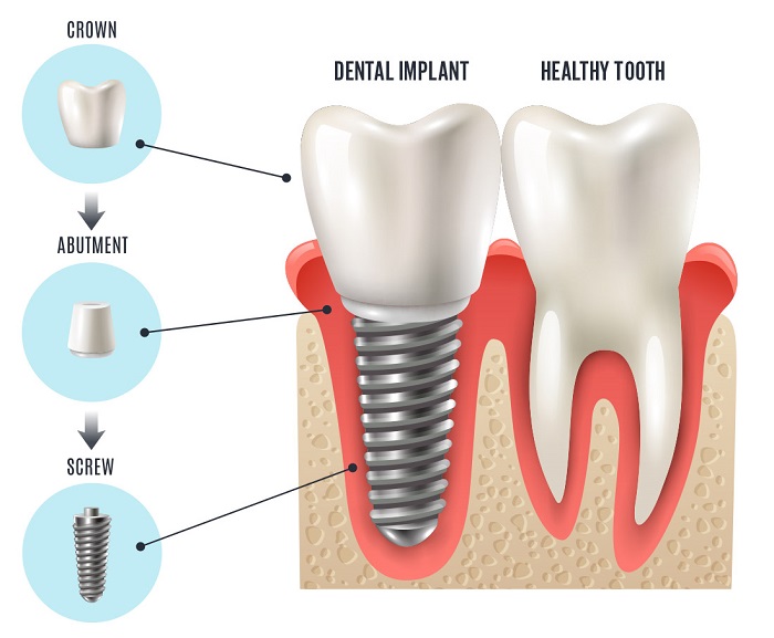 cấy ghép răng Implant có nguy hiểm không cấy ghép răng Implant có nguy hiểm không