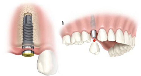 cấy ghép răng Implant có nguy hiểm không cấy ghép răng Implant có nguy hiểm không