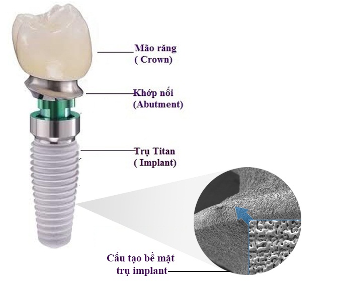 cấy ghép răng Implant mất bao nhiêu tiền cấy ghép răng Implant mất bao nhiêu tiền