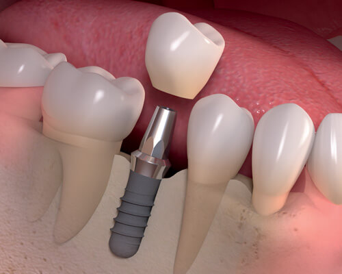 cấy ghép răng Implant ở đâu tốt cấy ghép răng Implant ở đâu tốt