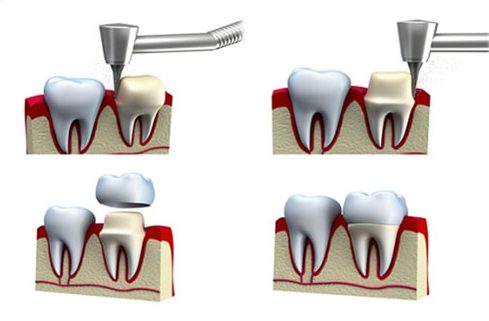 chụp răng sứ có tác hại gì
