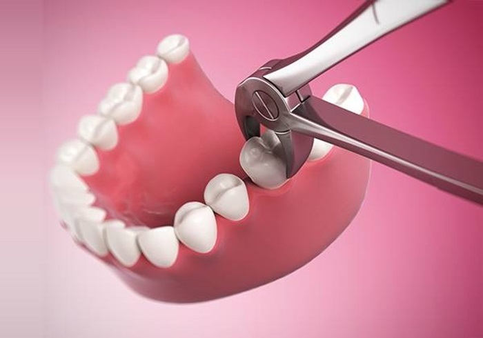 có nên trồng răng cấm không có nên trồng răng cấm không