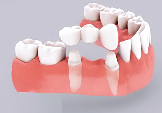 có nên trồng răng khểnh không có nên trồng răng khểnh không