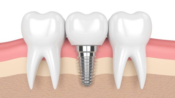 có nên trồng răng khểnh không có nên trồng răng khểnh không