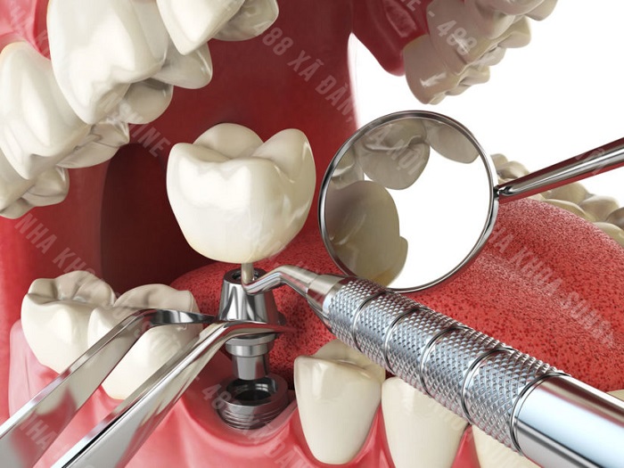 công nghệ cấy ghép Implant công nghệ cấy ghép Implant