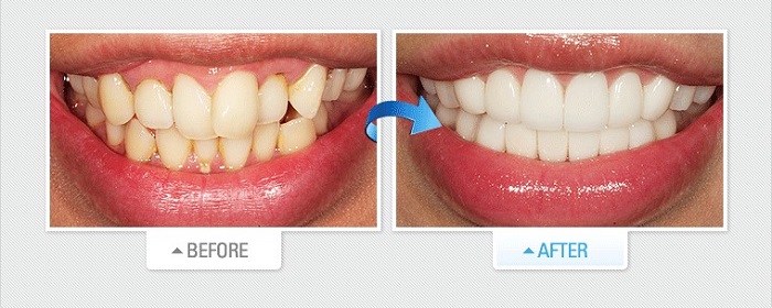 dán sứ veneer được bao lâu