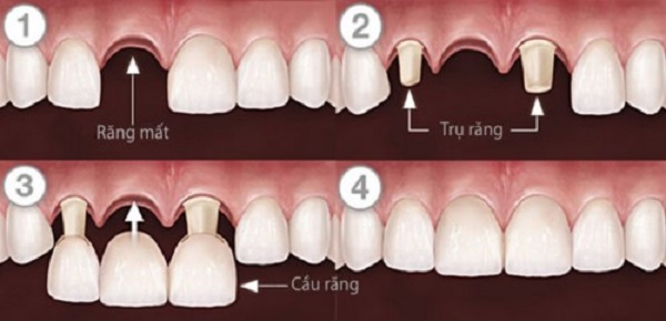 dịch vụ trồng răng khểnh dịch vụ trồng răng khểnh