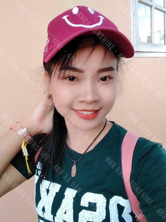 giá cả Implant giá cả Implant