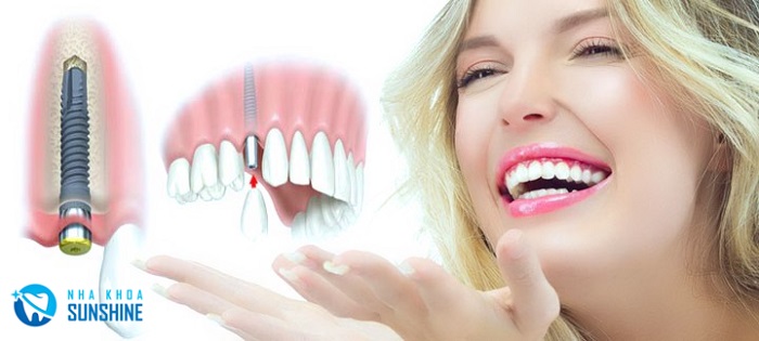 giá Implant Dentium Hàn Quốc giá Implant Dentium Hàn Quốc