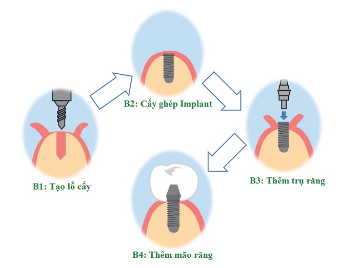 giá Implant Dentium Hàn Quốc giá Implant Dentium Hàn Quốc