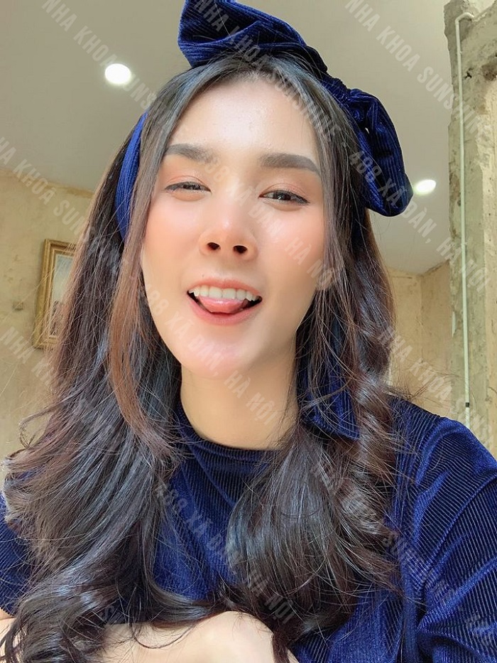 giá Implant Mỹ