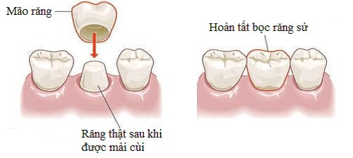 giá tiền trồng 1 cái răng