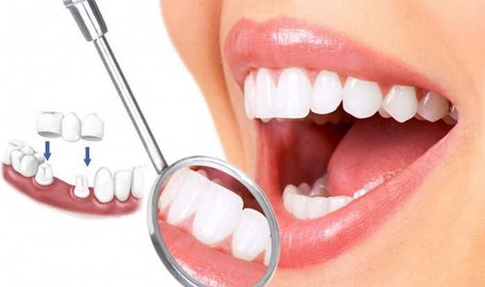 giá trồng răng bắc cầu