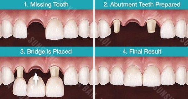 giá trồng răng bắc cầu