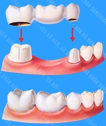 giá trồng răng bắc cầu