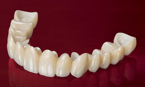 giá trồng răng bắc cầu