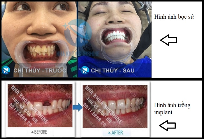 giá trồng răng giả ở hà nội