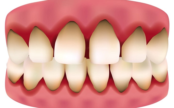 hình ảnh bọc răng sứ Titan