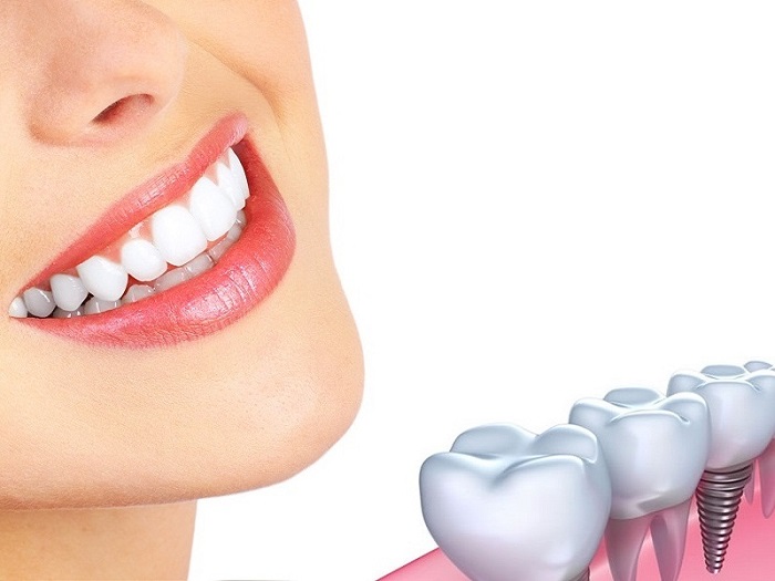 hình ảnh cấy ghép Implant