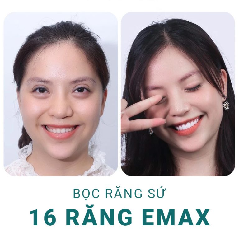 hinh-anh-truoc-sau-khi-boc-rang-su-emax