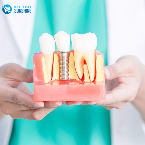 Implant osstem hàn quốc Implant osstem hàn quốc