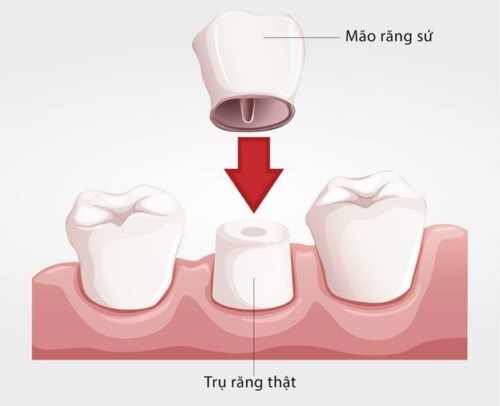 làm răng sứ bị tụt lợi 