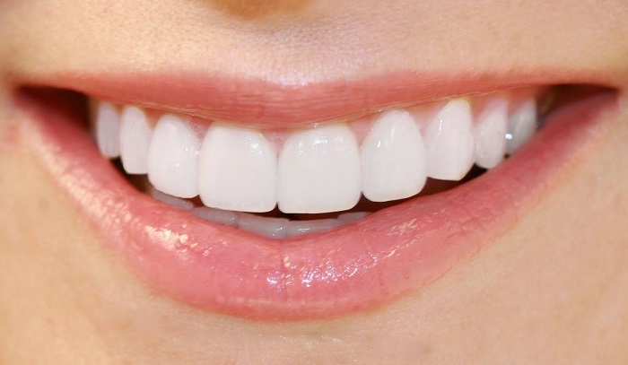 làm răng sứ bị tụt lợi 