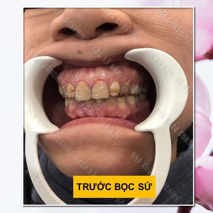 làm răng sứ có được bảo hiểm y tế không làm răng sứ có được bảo hiểm y tế không