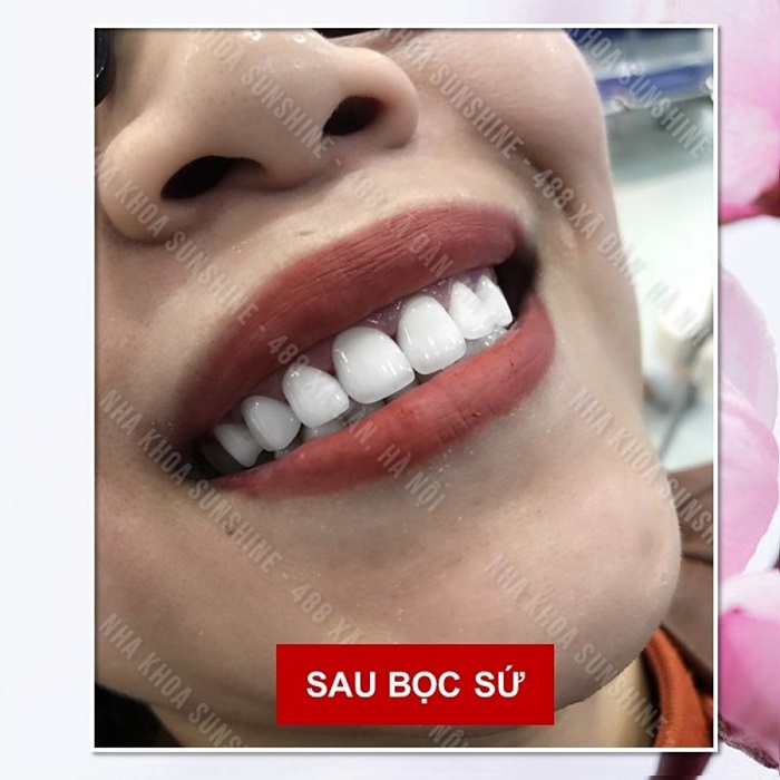 làm răng sứ có được bảo hiểm y tế không làm răng sứ có được bảo hiểm y tế không