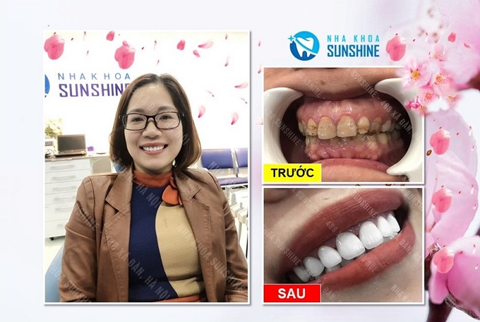 làm răng sứ có được bảo hiểm y tế không làm răng sứ có được bảo hiểm y tế không