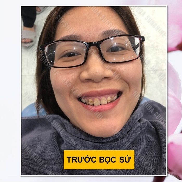 làm răng sứ có được bảo hiểm y tế không làm răng sứ có được bảo hiểm y tế không
