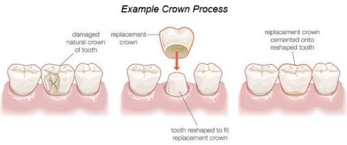 lợi ích và tác hại của bọc răng sứ