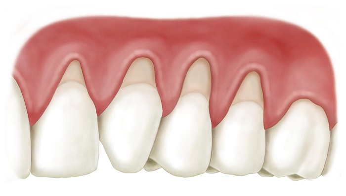lợi ích và tác hại của bọc răng sứ