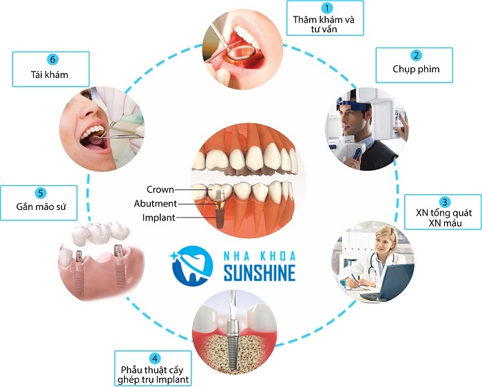 Nha Khoa chuyên Implant Nha Khoa chuyên Implant