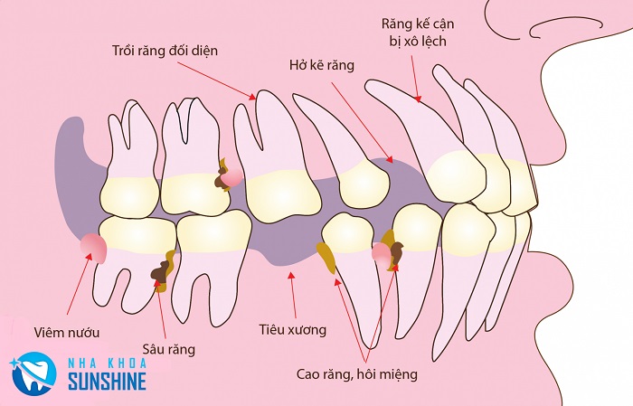 Nha Khoa chuyên Implant Nha Khoa chuyên Implant