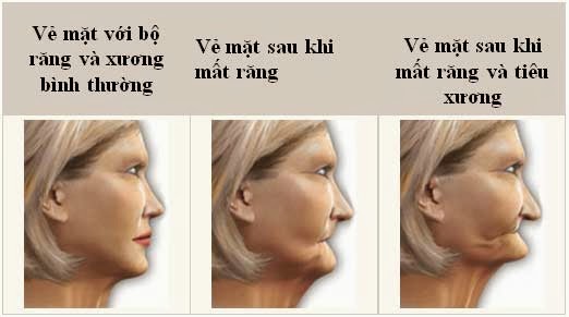 Nha Khoa chuyên Implant Nha Khoa chuyên Implant